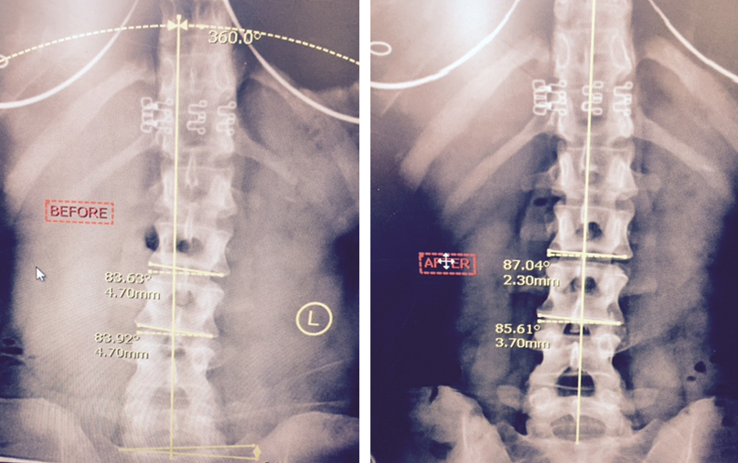 spinal-correction-1